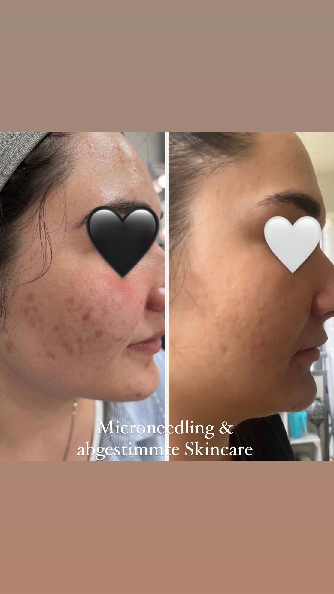 Online Microneedling Schulung